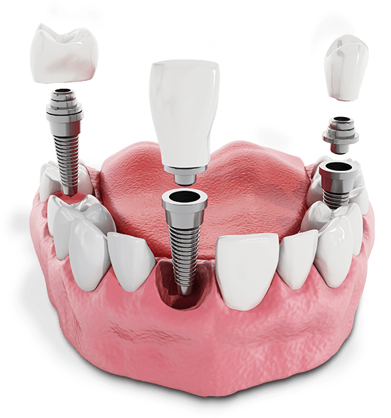 Model showing multiple dental implants